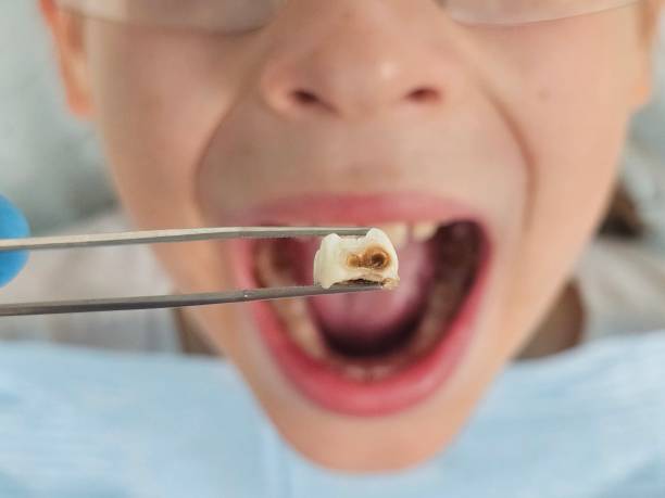 Best Emergency Treatment for Toothache in Irving, TX