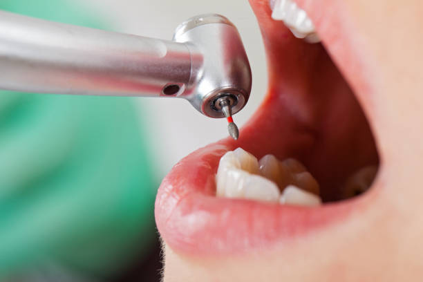 Best Emergency Tooth Extraction in Irving, TX